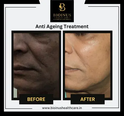 Results of Anti Ageing Treatment Bioinus Healthcare