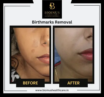 Results of Birthmarks Removal Bioinus Healthcare