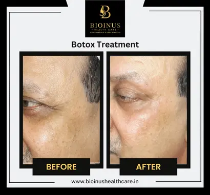 Results of Botox Treatment Bioinus Healthcare