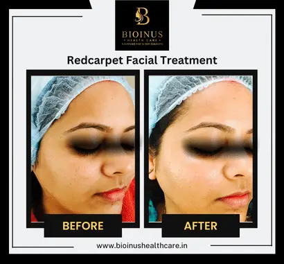 Results of Redcarpet Facial Treatment Bioinus Healthcare
