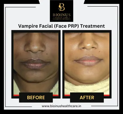 Results of Vampire Facial (Face PRP) Treatment Bioinus Healthcare (1)