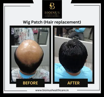 Results of Wig Patch (Hair replacement) Bioinus Healthcare (1)